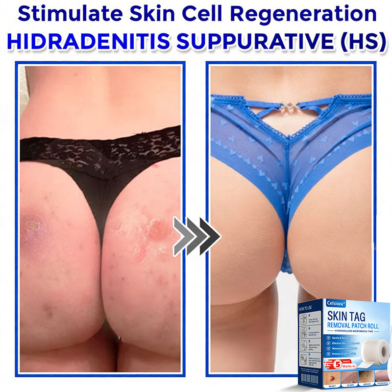 🧙‍♂️Celsiora® Multi-Functional Microneedle Hydrocolloid Patch Roll | Targets Skin Tags, Warts & Stubborn Blemishes