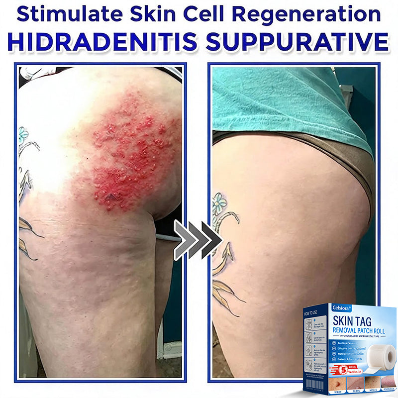 🧙‍♂️Celsiora® Multi-Functional Microneedle Hydrocolloid Patch Roll | Targets Skin Tags, Warts & Stubborn Blemishes