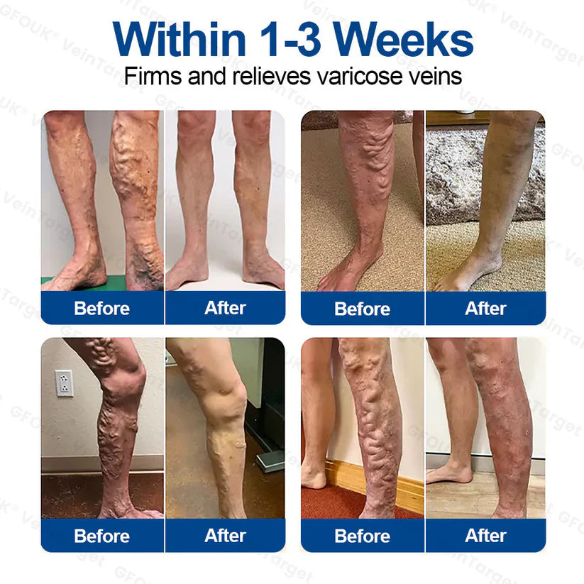 ✅GFOUK® VeinTarget Microneedle Patch⚡Instant Relief, Long-Term Results