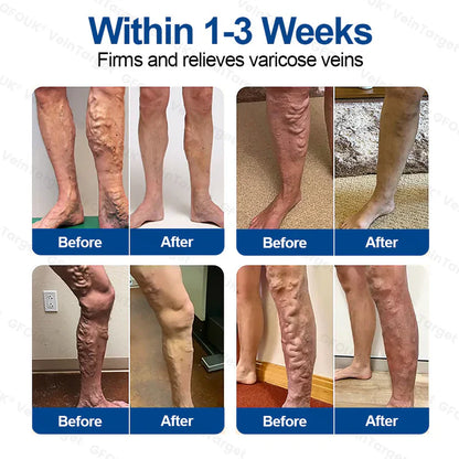 ✅GFOUK® VeinTarget Microneedle Patch⚡Instant Relief, Long-Term Results
