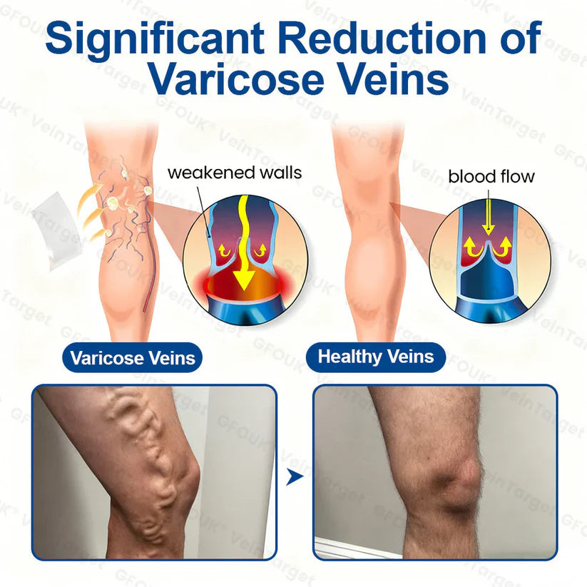 ✅GFOUK® VeinTarget Microneedle Patch⚡Instant Relief, Long-Term Results